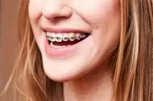 Close-up of a smiling young woman with traditional metal braces, highlighting orthodontic treatment options discussed in relation to braces costs and insurance coverage.