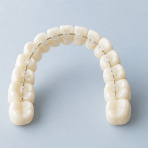Ceramic Braces for adults