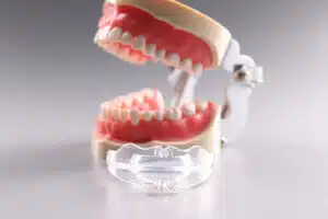 Model of teeth with orthodontic retainer, illustrating importance of retainers for maintaining dental alignment post-braces.