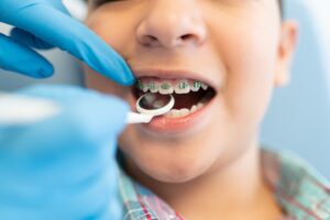 Signs Child Needs Orthodontist Visit at Age 7