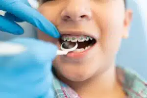 Child with braces undergoing orthodontic evaluation, orthodontist's gloved hand using dental tool to check teeth alignment and oral health.
