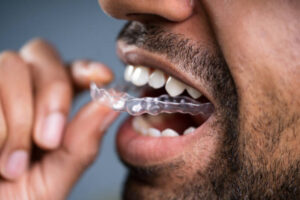 Invisalign for adults Pasadena orthodontic care