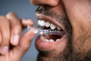 Man inserting clear Invisalign aligner into his mouth, demonstrating the discreet orthodontic treatment option for adults in Pasadena.