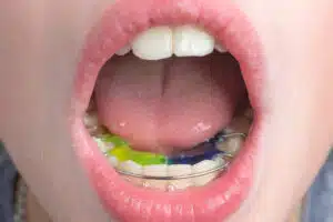 Child's mouth open showing colorful orthodontic appliance for early dental treatment, emphasizing proactive care for healthy smile development.