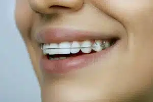 Smiling person wearing a clear retainer, showcasing healthy teeth and orthodontic results, relevant to retainer maintenance and care.