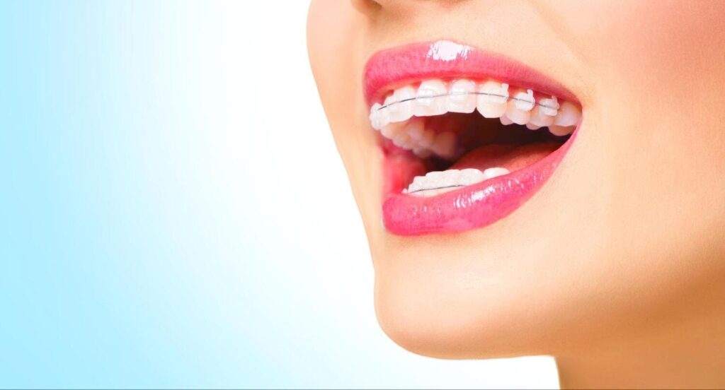 Adult Braces Options and Orthodontic Treatment in Glendale