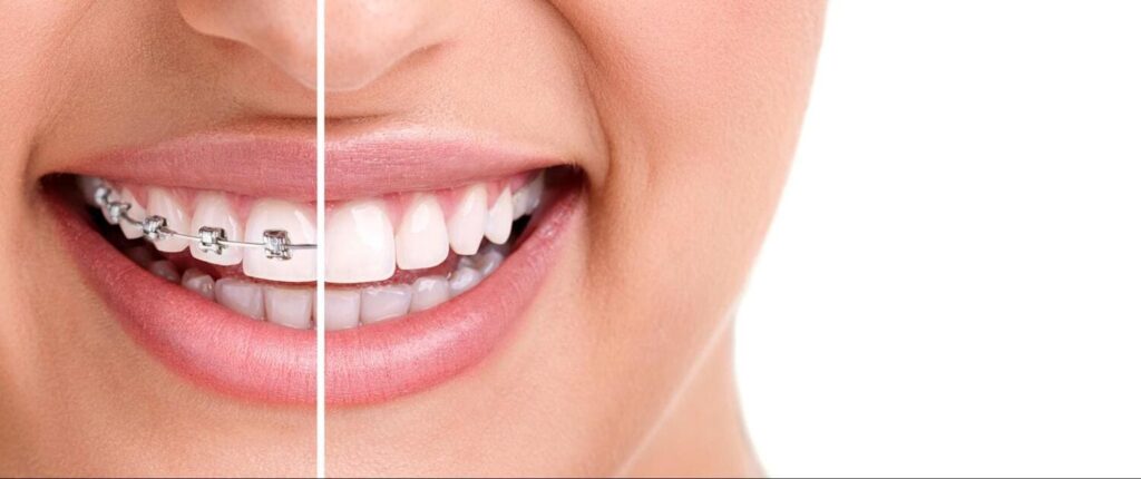 Adult Orthodontics Glendale – Braces and Invisalign for Adults