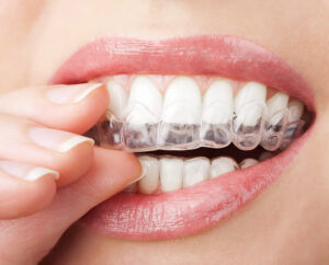 Invisalign for Adults – Clear Aligner Treatment Glendale