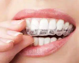 Invisalign for Adults – Clear Aligner Treatment Glendale