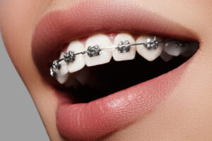 Orthodontic Hygiene Tips for Braces Care in Highland Park