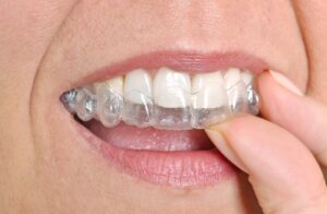 Benefits of Clear Aligners for Adults in Glendale