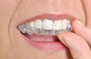 Person adjusting clear aligners on teeth, showcasing the convenience and comfort of Invisalign treatment for adults.