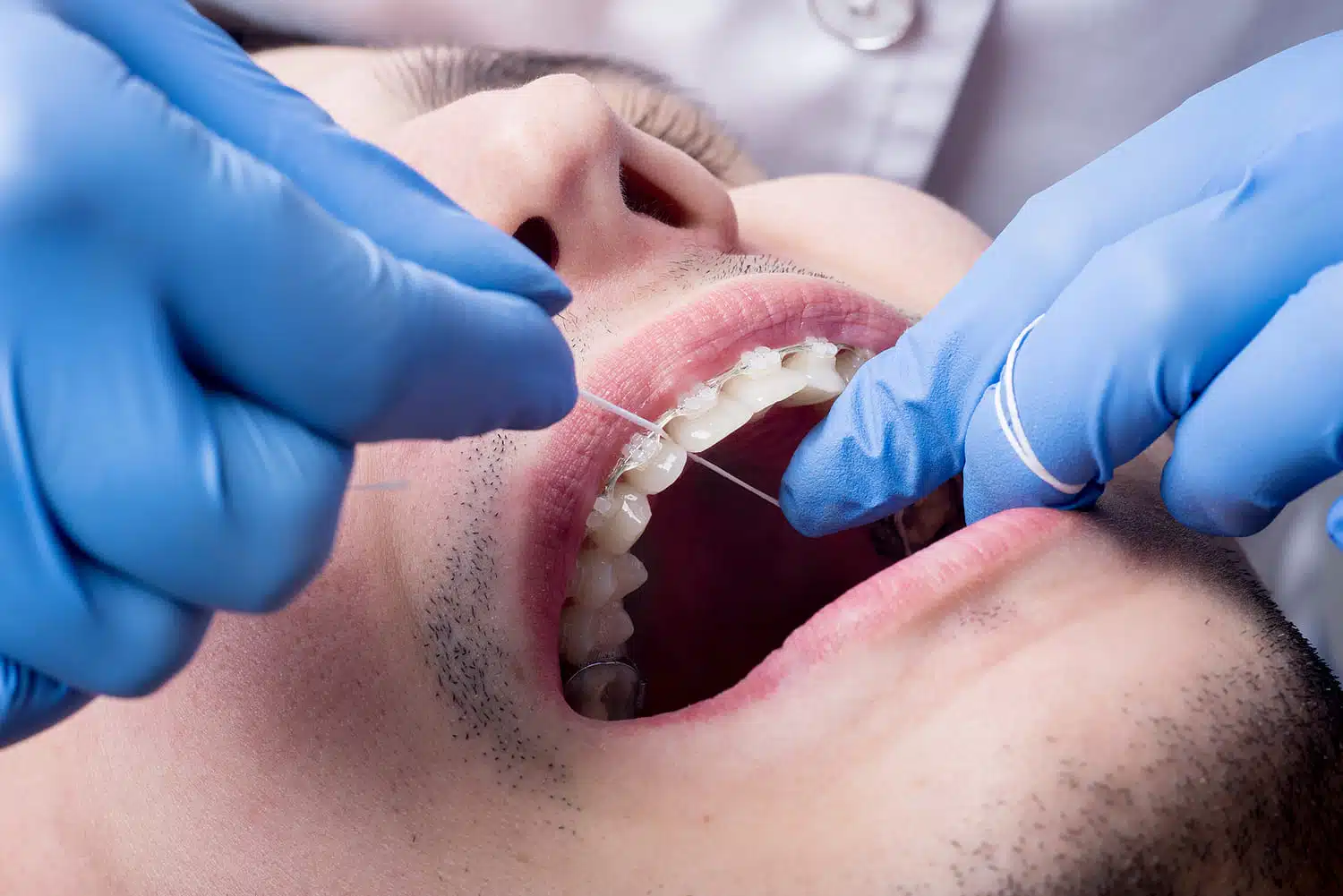 Patient receiving orthodontic care with clear aligners, demonstrating proper dental hygiene techniques with dental floss, highlighting the importance of maintenance in orthodontic treatment.
