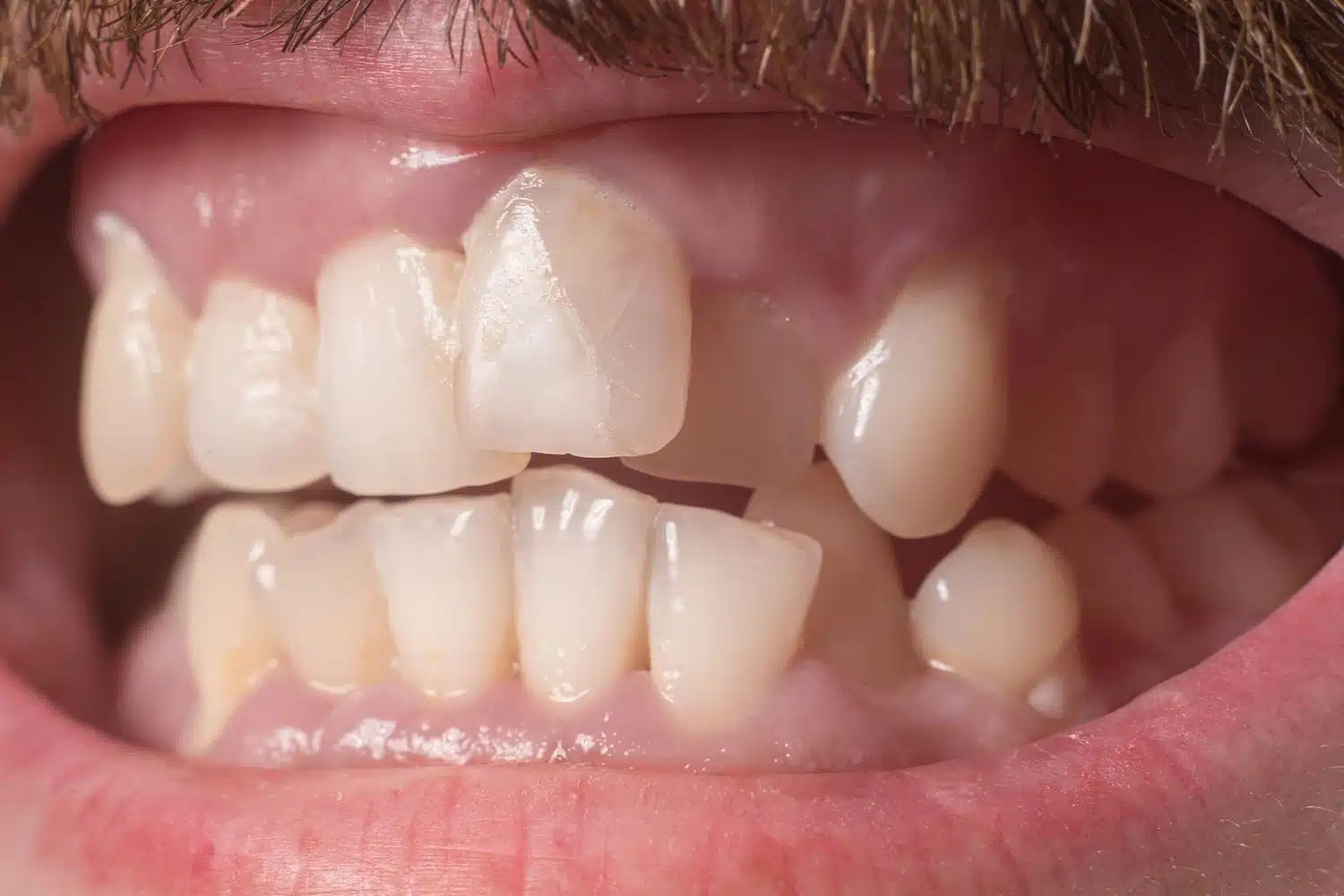 Close-up of crooked teeth with gaps, illustrating orthodontic treatment needs for patients considering braces or Invisalign.