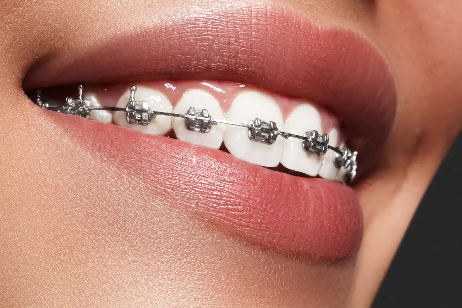 Close-up of a smile with traditional metal braces, highlighting orthodontic treatment for adults seeking a discreet and effective solution for teeth straightening.