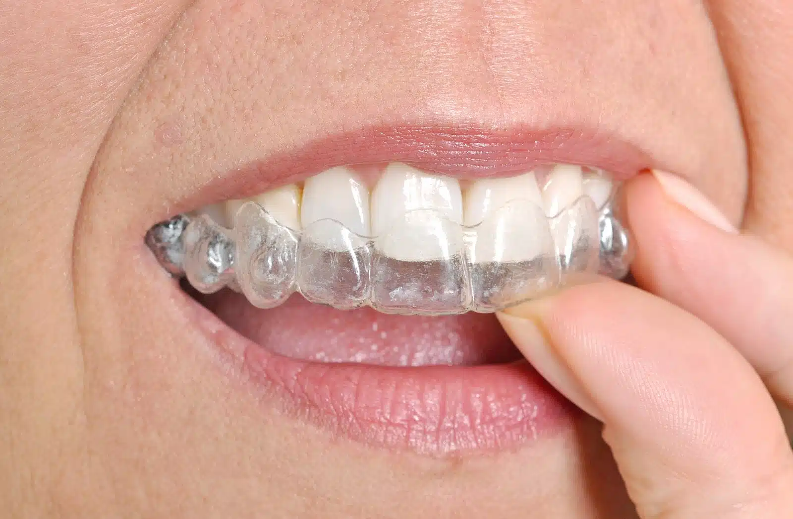 Close-up of a person inserting a clear Invisalign aligner over teeth, highlighting the orthodontic treatment process for adults.