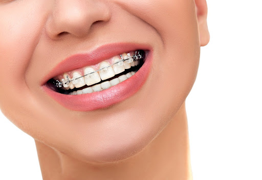 Close-up of an adult smile with braces, highlighting adult orthodontic treatment benefits
