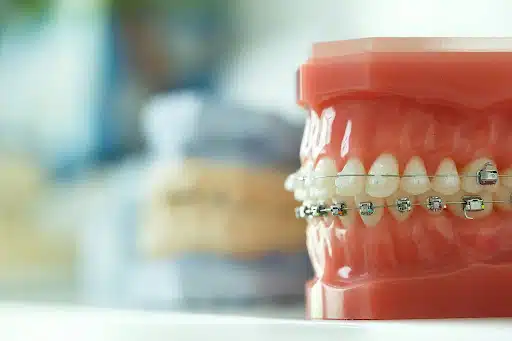 Dental model with braces showing functional orthodontic treatment for adults and proper alignment