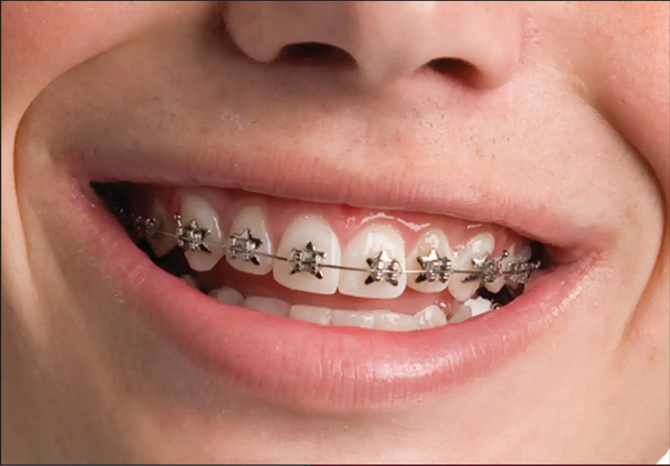 WildSmiles Star Smile Close Up